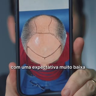 O Flávio chegou na clínica com uma expectativa muito baixa em relação ao transplante capilar...
Mas 