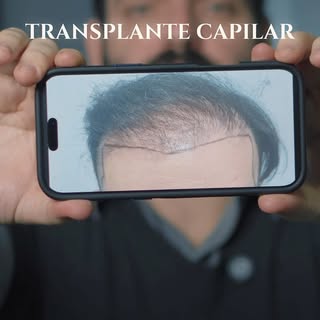 Você fez um transplante capilar e não teve o resultado que esperava? 🤦‍♂️ 

Com a técnica correta, 
