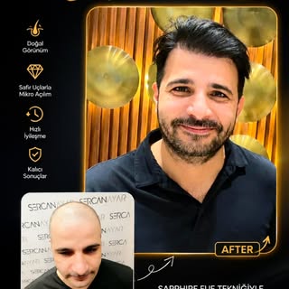 Sapphire FUE ile Doğal Görünüm, Kalıcı Sonuçlar

Sapphire FUE, safir uçlu özel mikro kanallar kullan