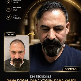 ✨ DHI Saç Ekimi ile Doğal Görünüm, Kalıcı Özgüven!

DHI (Direct Hair Implantation) tekniği sayesinde