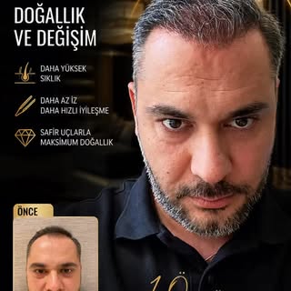 Sapphire FUE, klasik FUE tekniğinin geliştirilmiş bir versiyonudur. Bu yöntemde saç kökleri tek tek 