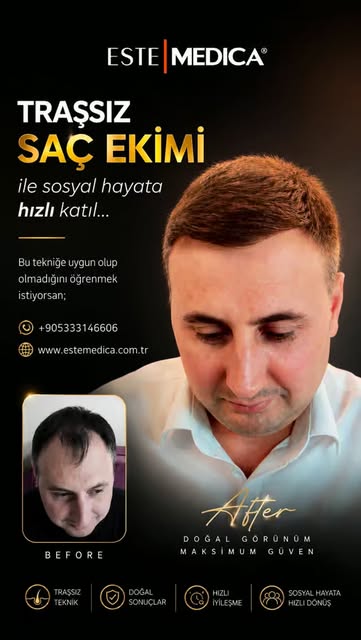 DHI Saç Ekimi Tekniği ile doğal, sık ve estetik bir görünüm hedefliyoruz. ✨

DHI tekniğinde saç kökl