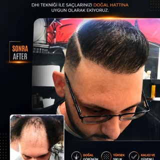 DHI saç ekimi, saç köklerinin özel DHI kalemi (Choi Implanter) kullanılarak doğrudan ekilmesini sağl