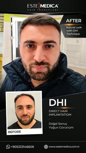 Doğru Yöntem, Doğal Sonuç

Her saç ekimi uygulaması kişiye özeldir. Saç yapınız, açıklık seviyeniz, 