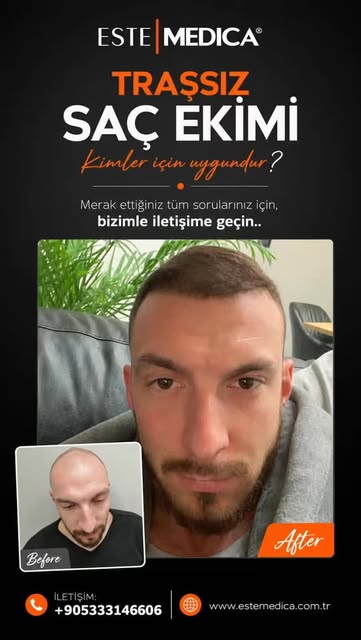TRAŞSIZ SAÇ EKİMİ ✨

Saçlarınızı tamamen tıraş ettirmeden, sosyal hayatınızdan uzaklaşmadan saç ekim