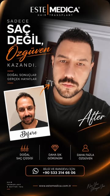 ✂️ SAÇLARINIZI KESTİRMEDEN YENİLENMEYE HAZIR MISINIZ?

DHI Tıraşsız Saç Ekimi ile mevcut saçlarınızı