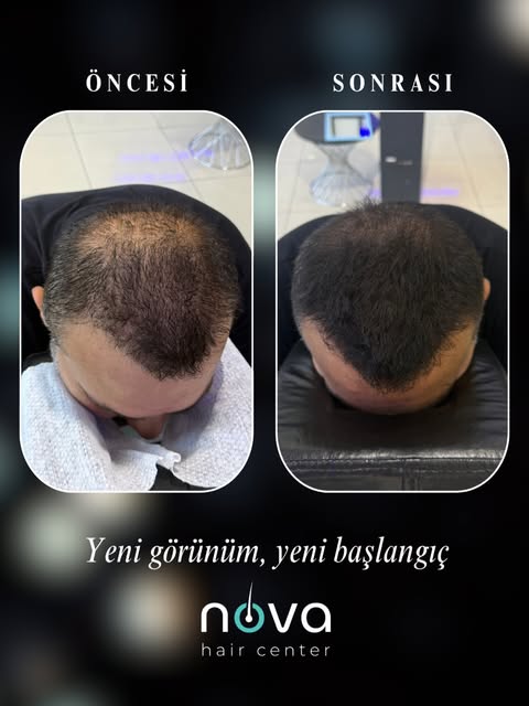Saç dökülmesi, seyrek bölgeler ve saç ekimi sonrası kapanmayan alanlar artık kaderiniz olmak zorunda