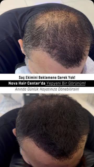 Saç dökülmesi, seyrek bölgeler ve saç ekimi sonrası kapanmayan alanlar artık kaderiniz olmak zorunda