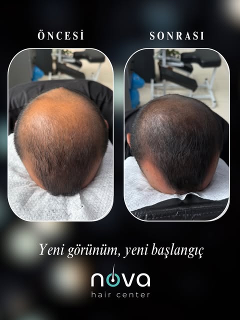 Saç dökülmesi, seyrek bölgeler ve saç ekimi sonrası kapanmayan alanlar artık kaderiniz olmak zorunda