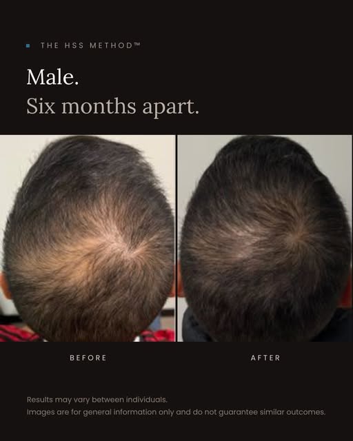 Hair trivia 🧬 Male pattern hair loss is called a “pattern” for a reason. Follicles around the hairl