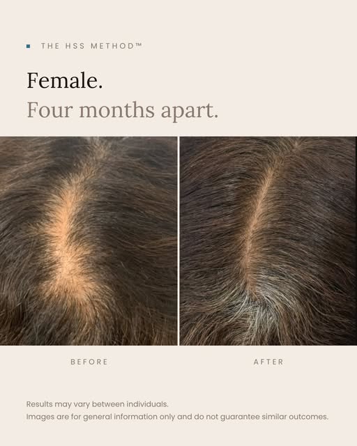 Hair changes can be gradual, which is why progress is often best appreciated over time.

Here are fi
