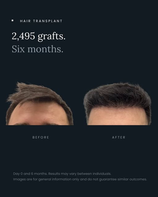 Six months of progress following a 2,495-graft hair transplant. 🌱

At this stage, new growth is bec