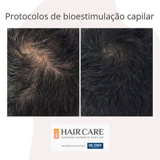 Tratamentos combinados de Mesoterapia Capilar e Microagulhamento 🙌 

Os resultados são o resultado