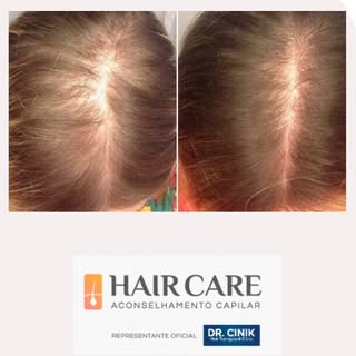 A Mesoterapia Capilar consiste na injeção intradérmica de proteínas, vitaminas, aminoácidos, sais mi