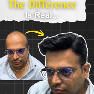 Hair loss doesn't define you. Confidence does. 💯

Watch this incredible transformation with our pre