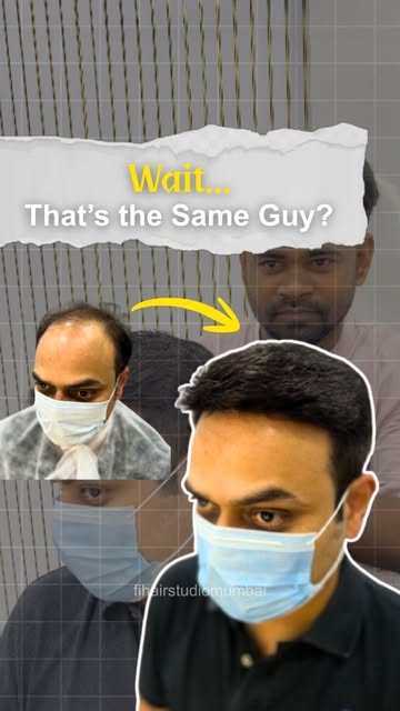 Hair Patch Before & After 🔥

From visible hair loss to a natural-looking hairline.

This non-surgic