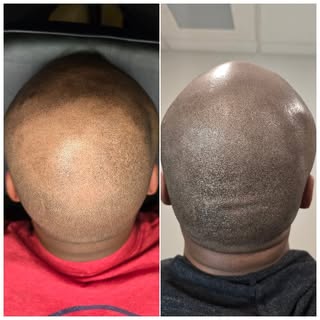 Just so satisfying. 

In time for his wedding. 
This client came in the nick of time
Lots don't know