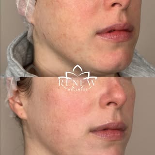 Ready for that “I woke up like this” glow? ✨

Microneedling works by gently stimulating your skin’s 