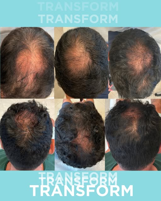 A transformation 9 months in the making. ✨
This patient’s hair regrowth journey was achieved through