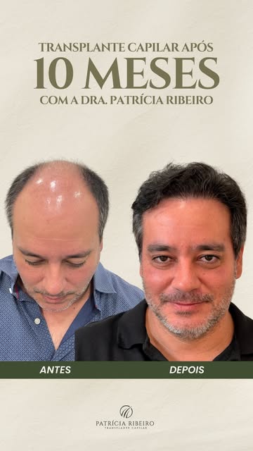 A arte da naturalidade no Transplante Capilar. 

Muitos pacientes têm receio de resultados artificia