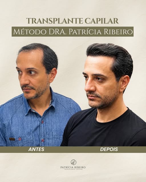 Um bom transplante capilar não chama atenção pelo procedimento. Ele chama atenção pela naturalidade 