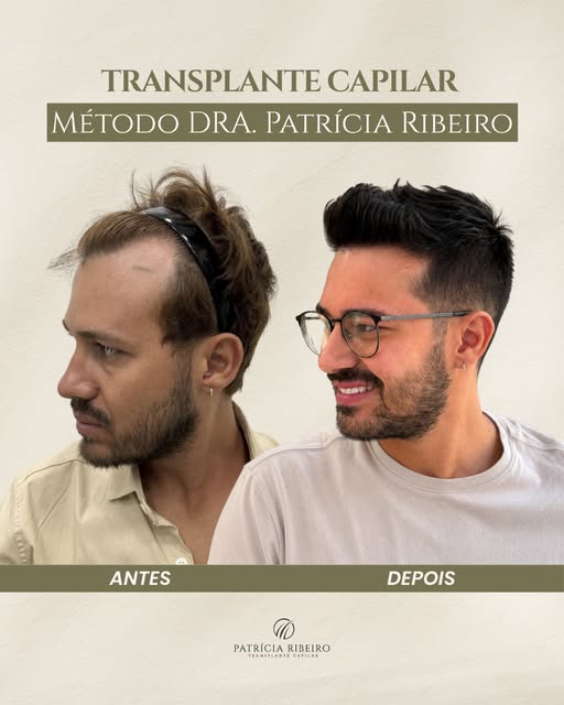Apenas 7 meses?!? Simmm

Um transplante capilar bem indicado vai muito além de preencher áreas com m