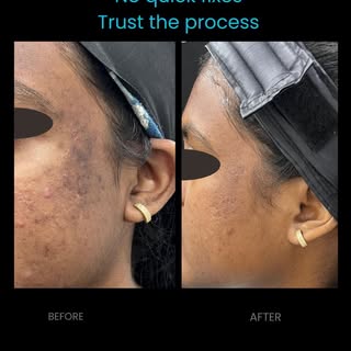 Real transformation isn’t a miracle—it’s a clinical journey. 🧬 
9 sessions and 12 months of dedicat