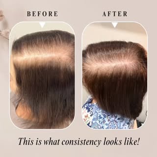 One year. One personalized plan. Incredible progress. ✨
This client completed my Hair Recovery Progr