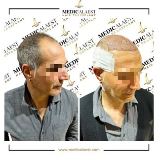Hair Replacement at MEDICALAEST clinic, the best experience. CALL US FOR FREE AND GET A FREE CONSULT