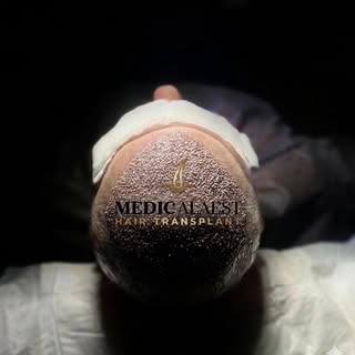 The “Elite Standard” (Focus on Quality)

Precision in every graft. Luxury in every detail. ✍️✨
We do