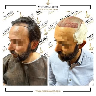 Your journey to a fuller head of hair starts with a single, precise step. 👑
At MedicalAest, we comb