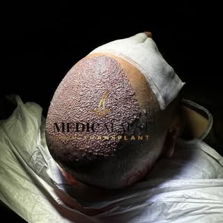 Defining the art of the transplant. 🖤✨
Where medical expertise meets aesthetic excellence.
DM for a