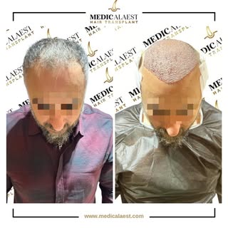 Perfect for a clean, aesthetic graphic.
Is it time for a transplant? ✍️
1. Stabilized Hair Loss: Are