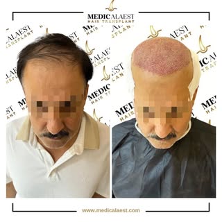 Precision is the foundation of a natural-looking hairline. 📐✨
Take a look at this incredible transf