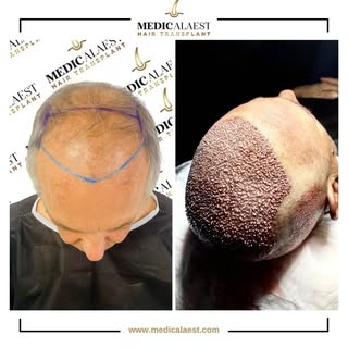 The best investment you can make is in yourself. 🌟
A hair transplant is more than just a procedure—
