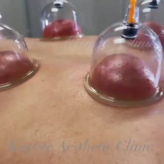 @kayvee_skinhair_aesthetic Here is my very very Happy patient from Singapore feedback for his cuppin