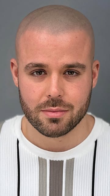 Zoom in on the hairline.
Natural Hairline SMP with Ultra Tiny Dots
By Marcin Adam | MicroHair® Liver