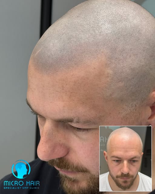 THIS IS A HAIR TATTOO.
Healed - One session left.
Artist work : Marcin Adam. 
#SMP #scalpmicropigmen