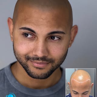Scalp Micropigmentation SMP by Marcin Adam, one of the UK’s most experienced SMP artists.

✓ 12+ yea