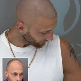 THIS IS AN SMP HAIR TATTOO.

Work done by SMP Expert Practitioner Marcin Adam at MicroHair® Liverpoo