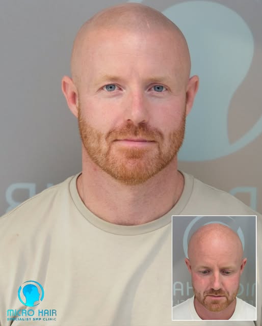 GINGER HAIR & SMP

A lot of men with fair or ginger hair assume SMP isn’t an option for them. This r
