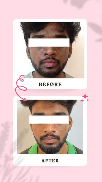 Pico Laser Treatment in Chennai for Clearer & More Even-Looking Skin

Struggling with skin pigmentat