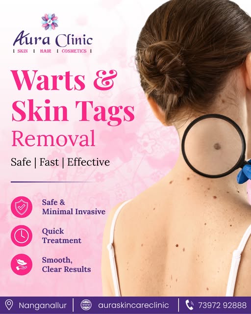 Looking for Warts & Skin Tags Removal in Nanganallur, Chennai? 🌸

Aura Clinic provides professional