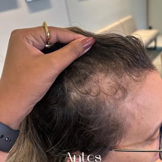 Você sabia que queda de cabelo, afinamento dos fios, calvície, alopecia androgenética têm tratamento