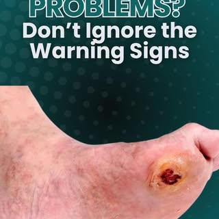 From small corns to pus-filled wounds and swelling — every diabetic foot issue needs attention.
Earl