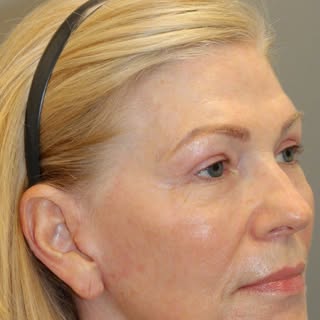 Incredible before and afters of our gorgeous 64 year old patient just 9 weeks post-op 🌟

Procedures