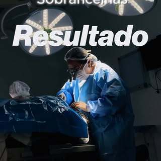 Esse é o resultado REAL de um transplante de sobrancelhas 16 meses após o procedimento.

Utilizando 