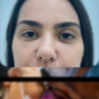 Blefaroplastia superior em pacientes jovens para abertura do olhar