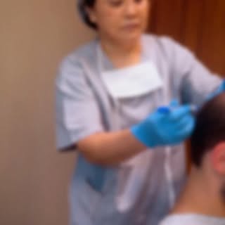 Pós operatório tardio de 12 meses de transplante capilar FUE em calvície extensa ; grau V