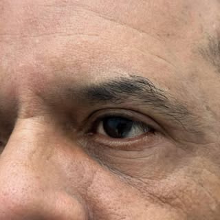 06 meses de pós operatório de blefaroplastia superior
